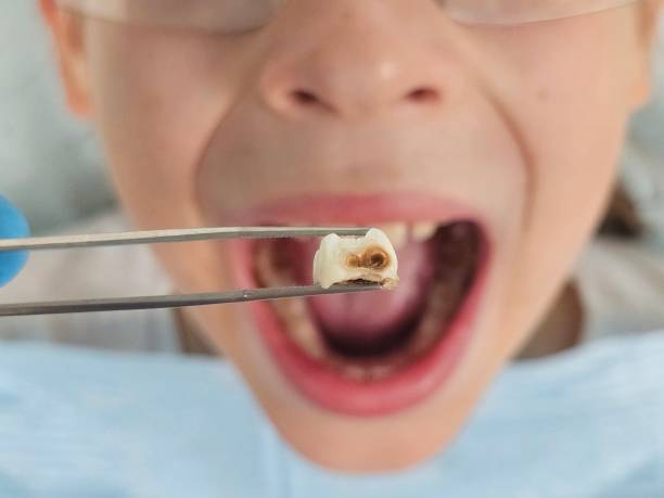 Best Emergency Wisdom Teeth Removal in Asheville, NC