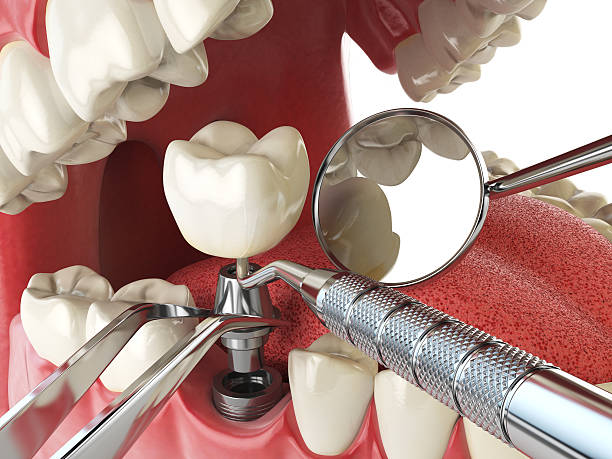 Best Emergency Root Canal Treatment in Asheville, NC